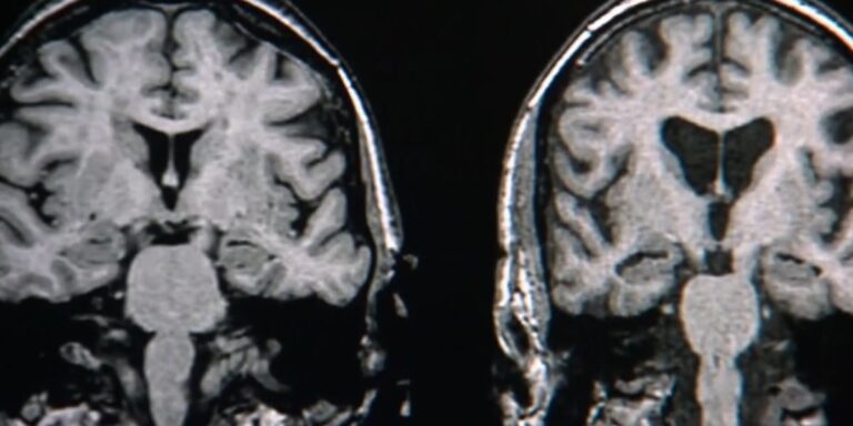 IL House committee unanimously approves bill expanding insurance coverage for Alzheimer’s treatment